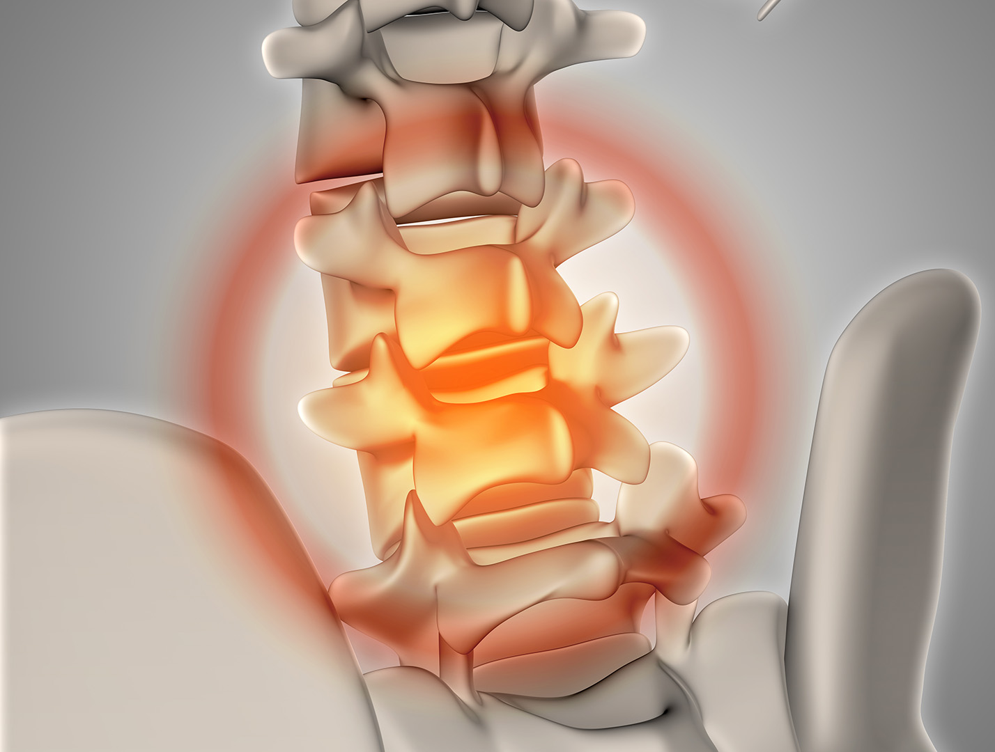 Representación en 3D de un infarto medular. La imagen muestra una columna vertebral con un circulo naranjo brillante mostrando dónde ocurre el infarto medular